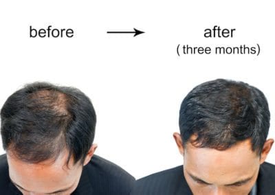 Male Pattern Baldness Featured Image